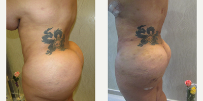 25-34 year old woman treated with Brazilian Butt Lift Revision - This patient had a BBL 1 year ago with another PS, she came for a revision to achieve a more natural, anatomical look