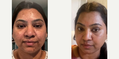 Woman treated with Halo Laser - Woman treated with Halo Laser