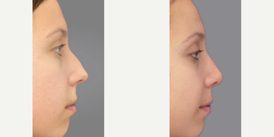 Woman treated with Rhinoplasty - Woman treated with Rhinoplasty