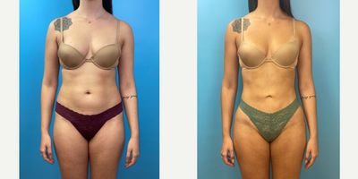 25-34 year old woman treated with Brazilian Butt Lift - This young patient is shown 2 months following a skinny Brazilian Butt Lift (BBL) with 360 Lipo. Oftentimes in patients who do not have much fat, a BBL can be more about what you take out, and less about what you put in. With careful liposuction of the abdomen, flanks, and back in this patient, I tried to snatch the waist to accentuate her buttock contour and placed the harvested fat predominantly in the hip dips to optimize her hourglass figure. As always, extra time was taken in the OR to filter, purify, and concentrate the suctioned fat prior to injecting it safely into the buttocks to maximize fat graft take.