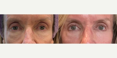 45-54 year old woman treated with Laser Resurfacing, Fractional Laser, Nonsurgical Facelift, Skin Tightening, Skin Rejuvenation - 1 month after full face and neck with focused periorbital Moxi laser treatment