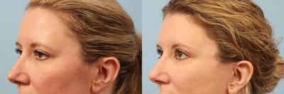 43 year old woman treated with Eyelid Surgery - 43 year old woman treated with Eyelid Surgery