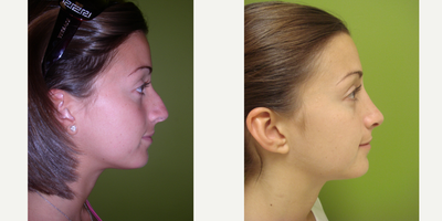 18-24 year old woman treated with Rhinoplasty - This patient underwent a Rhinoplasty