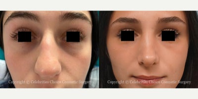 18-24 year old woman treated with Rhinoplasty - This patient had Cosmetic reduction Rhinoplasty performed through a closed technique