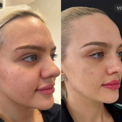 18-24 year old woman treated with Morpheus8, CO2 Laser, Collagen Injection, Skin Rejuvenation, Skin Tightening, Botox, Dermal Fi - Subtle yet transformative! 1 Growth Factors: Target under-eye hollowness and dark circles.2 Neurotoxins: Slim the jawline and create a subtle eyebrow lift.3 Morpheus8 + CoolPeel: Combined with exosomes to elevate skin quality and integrity.4 Strategically Placed Filler: Enhance facial balance by addressing the chin and marionette lines.Thoughtfully crafted for natural, radiant results!