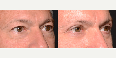 45-54 year old male treated with Eyelid Surgery - Patient came in wanting to fix his droopy eyelids and under-eye bags.