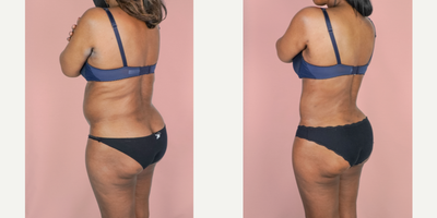 55-64 year old woman treated with Tumescent Vaser Liposuction Revision - This patient had prior liposuction by another surgeon but this left her with residual fat and an unsatisfying result. She is shown here 3 months post-op from 360 Lipo suction. She was finally able to achieve a cinched waistline and smooth contour.