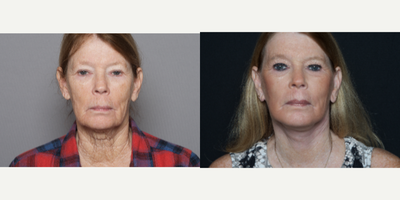 65-74 year old woman treated with Facelift - 65-74 year old woman treated with Facelift