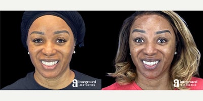 55-64 year old woman treated with Dysport - The patient is a 58-year-old female who had concerns about fine lines and wrinkles. Dr. Chiang used wrinkle relaxer (Dysport or Chotox) for the forehead, glabella, crows feet, bunny lines, chin, masseters, and neck bands to address these concerns. The after results are 3 weeks post-treatment.