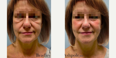 Woman in her 50s treated with Cheek Fillers - Woman in her 50s treated with Cheek Fillers using 1 syringe of Voluma