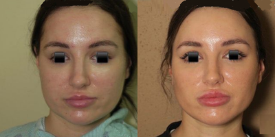 Woman treated with Liposuction - Woman treated with Neck Liposuction