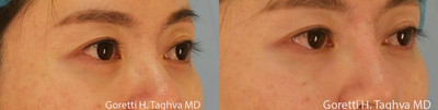 18-24 year old woman treated with Radiesse - Radiesse was used to augment her radix/ nasal bridge. (Voluble was also injected to soften her tear troughs)