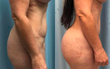 35-44 year old woman treated with Brazilian Butt Lift - Brazilian Butt Lift: Liposuction 360 with fat transfer