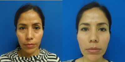 Patient Case #restylane and fillers patient - Injected 0.5 cc restylane into each infraorbital area, and one cc in each nasolabial fold to achieve a younger and more rested appearance in a restylane patient.