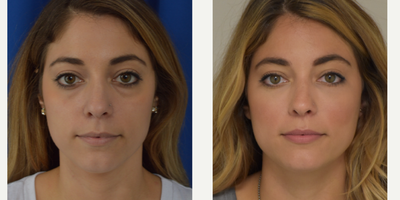 35-44 year old woman treated with Juvederm - Juvederm Ultra and Voluma to treat tear trough area, eye bags, and cheek augmentation.Dr. Sean Weiss