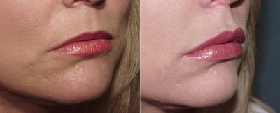 Juvederm Lip Augmentation -
Patient brought in a picture of Jennifer Garner, asking for her lips. She wanted very full lips, which we achieved.