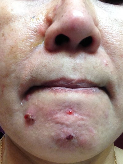 acne adult cyst acne adult cyst