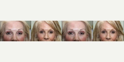 55-64 year old woman treated with Chemical Peel, Eyelid Surgery - Before & After: Upper & lower Blepharoplasty & Hetter peel to under eyes Sometimes a subtle change can make the biggest difference. This patient decided to refresh her look with upper and lower eyelid surgery with Dr. Kass and she couldnt be happier with the results!