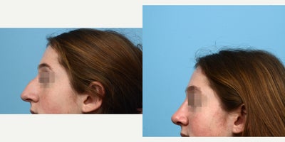 18-24 year old woman treated with Septoplasty - Looking for a natural rhinoplasty result, this patient turned to Dr. Wise. Two months after her nose surgery, she loves the new look and appreciates her ability to breathe better.