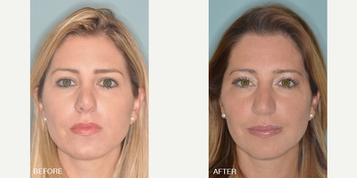 35-44 year old woman treated with Facelift - Revision rhinoplasty of a female patient with a significantly foreshortened nose. Patient had undergone a previous rhinoplasty 10 years prior. Her main concerns were the unnatural appearance of her tip, being upturned and foreshortened. Her frontal view showed an amorphous and upturned nasal tip with excessive nostril show and significant asymmetry. Her profile view showed the significantly upturned tip. During surgery, her nasal tip cartilages were found to have been nearly completely removed and she was found to have significant scarring. Her challenging procedure entailed the use of rib cartilage to reconstruct her tip cartilages. A septal extension graft was used to help counter-rotate her tip. Lateral crural strut grafts were used to recreate her tip cartilages. The patient is seen here 3 months post-op.