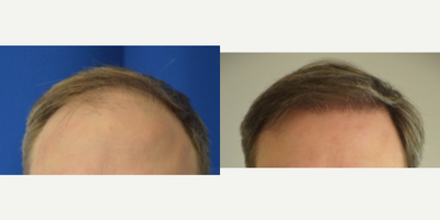 35-44 year old man treated with Hair Loss Treatment - ARTAS robotic hair restoration treatment for hair loss in New Orleans, Louisiana