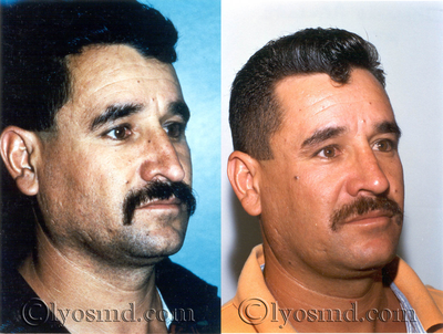 Rhinoplasty, Septoplasty -
39-year-old gentleman before and after rhinoplasty and correction of breathing difficulties.