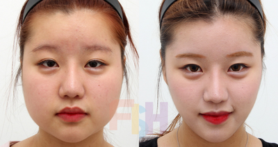 25-34 year old woman treated with AccuLift - 25-34 year old woman treated with AccuLift on front cheek, lower side cheek, double chinand jowl line.