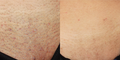 25-34 year old woman treated with Laser Hair Removal - Laser hair removal at bikini line