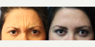 First Time Injectable Patient - This patient was concerned with the lines in her forehead. She had never had Dysport or Botox before.
