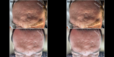 25-34 year old man treated with Laser Resurfacing, Microneedling RF, PRP Injections, Microneedling, Alastin Skincare - SEVERAL COMBINATION TREATMENTS WITH SUBCISION, RF MICRONEEDLING, LASER AND EXOSOMES BY DR.SHANTHALA