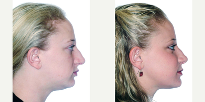 18-24 year old woman treated with Orthognathic Surgery - Upper Jaw Forward
Lower Jaw Forward
Chin Forward and Down
Counterclockwise Face Rotation
Cheek Implants