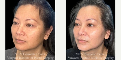 45-54 year old woman treated with CoolPeel, Skin Lightening, CO2 Laser, Skin Rejuvenation, IPL - This patient underwent a single combination treatment of CoolPeel laser skin resurfacing and the Elluminate Advanced Photofacial (with IPL) to brighten dull skin, soften sun damage, and improve overall facial clarity.Her after photos show a noticeably more radiant complexion with improved skin tone, smoother texture, and reduced pigmentation irregularities across the cheeks, forehead, and under-eye area. Fine lines appear softer, pores look more refined, and the overall surface of the skin appears healthier and more even.CoolPeel works by delivering controlled, superficial CO resurfacing with minimal downtime, while the Elluminate Photofacial targets multiple layers of discolorationfrom sun spots to rednessto produce a clearer, more luminous complexion. Together, these technologies complement one another to deliver a refreshed, rejuvenated look in just one session.This combination treatment is ideal for patients who want visible brightening and smoothing benefits with little to no downtime and a naturally refreshed appearance.
