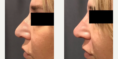 Woman treated with Nonsurgical Nose Job - Non-surgical rhinoplasty done by Dr. Marciano Achieve amazing results in just minutes!!