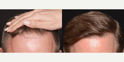 Woman treated with NeoGraft, Hair Transplant - Did you know that 50 million men and 30 million women, including many in the DFW area, suffer from thinning hair? When it happens, hair loss can be very distressing. At Beyond Beautiful Texas, we offer the NeoGraft Hair Transplantation System to men and women who suffer from male/female pattern baldness or thinning hair.If you have a receding hairline, let us help you get that fullness back with NeoGraft! Dr.Ho can help you restore your good looks with your own hair. With NeoGraft, you feel NO PAIN and the results are PERMANENT.