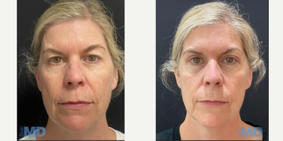 45-54 year old woman treated with Eyelid Surgery - Blepharoplasty (eyelid) surgery - upper lids.