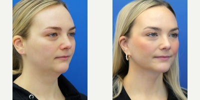 25-34 year old woman treated with Neck Lift - Necklifts are not reserved only for aging individuals. Platysmaplasty, subplatysmal lipectomy, and lateral platysmal suspension work in harmony to reduce midline bulk and define neck angle for a natural result.