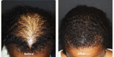 Man treated with Hair Loss Treatment - Man treated with Hair Loss Treatment