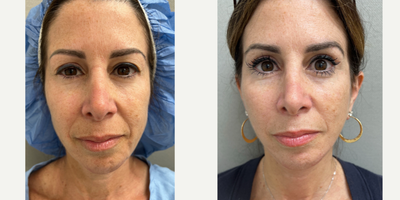 45-54 year old woman treated with NaturalLift - 51 y/o, 3 most after NaturalLift in our office OR under sedation