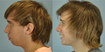 18-24 year old man treated with Chin Implant - This 25 year old was treated with Chin Implant.