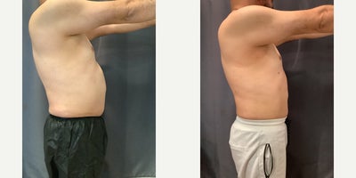 45-54 year old man treated with Smart Lipo - Smartlipo of abdomen