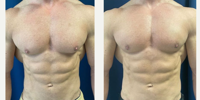 Gynecomastia Surgery - Treated with Gynecomastia Surgery