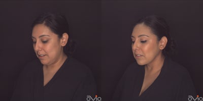 35-44 year old woman treated with MyEllevate - 6 weeks post MyEllevate with liposuction and RF energy