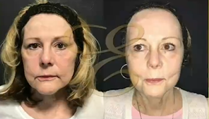 Woman treated with Laser Resurfacing - Woman treated with Laser Resurfacing