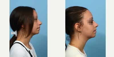 18-24 year old woman treated with Nonsurgical Nose Job - This patient opted for a non-surgical rhinoplasty with Dr. Wise to avoid the downtime associated with a surgical procedure. With strategic placement of dermal fillers, Dr. Wise was able to mask the bump on her nose. She loves the result.