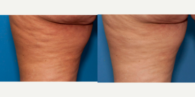 44 year old woman treated with Aveli - Aveli for buttock and thigh cellulite
