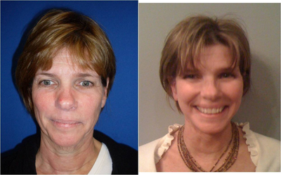 Facelift -
before and after pictures of facelift (minifacelift) performed under local anesthetic.