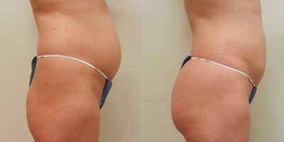 25-34 year old woman treated with Vaser Liposuction (abdomen, upper and lower back and waistline) - 25-34 year old woman treated with Vaser Liposuction (abdomen, upper and lower back and waistline)