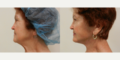 Facelift - The Art of Plastic Surgery, Dr. Gregory A. Wiener, MD FACS