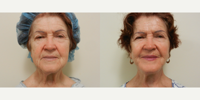 Facelift - The Art of Plastic Surgery, Dr. Gregory A. Wiener, MD FACS