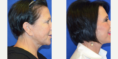 65-74 year old woman treated with Laser Treatment - This patient came to our practice wanting to rejuvenate her appearance for her career and personal life. After visiting with Dr. Ho, the patient elected to have a face/neck lift and laser skin resurfacing procedure.